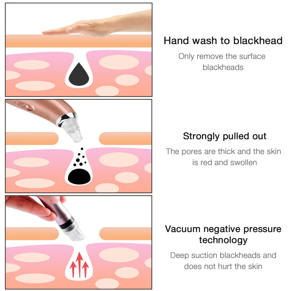 Microbubble Blackhead Remover